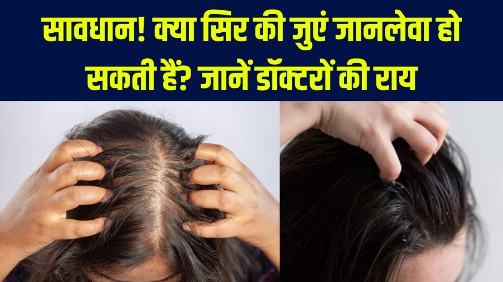 सावधान! सिर की जुएं भी बन सकती हैं जानलेवा? 12 साल की बच्ची की मौत ने उड़ाए होश; डॉक्टर से जानें कब गंभीर हो जाती है यह समस्या 1 सावधान! सिर की जुएं भी बन सकती हैं जानलेवा? 12 साल की बच्ची की मौत ने उड़ाए होश; डॉक्टर से जानें कब गंभीर हो जाती है यह समस्या